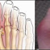 Obat Asam Urat Alami Dan Aman thumbnail