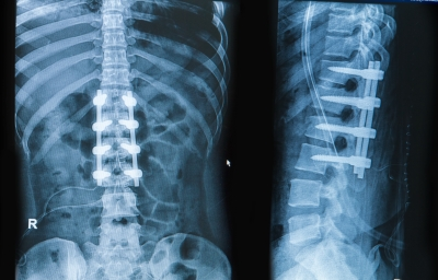 Road traffic accident claims