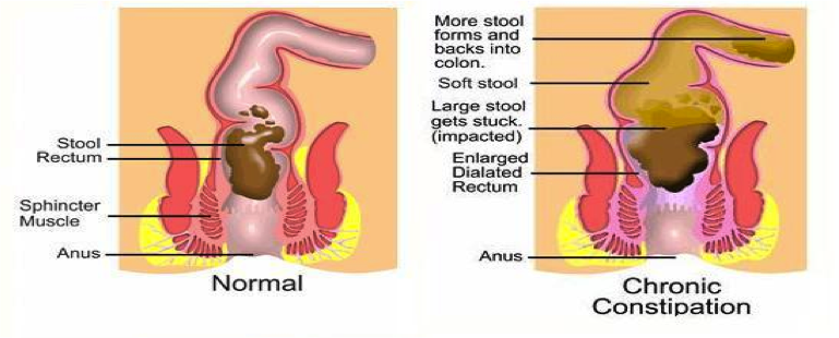 Does rice cause constipation in adults