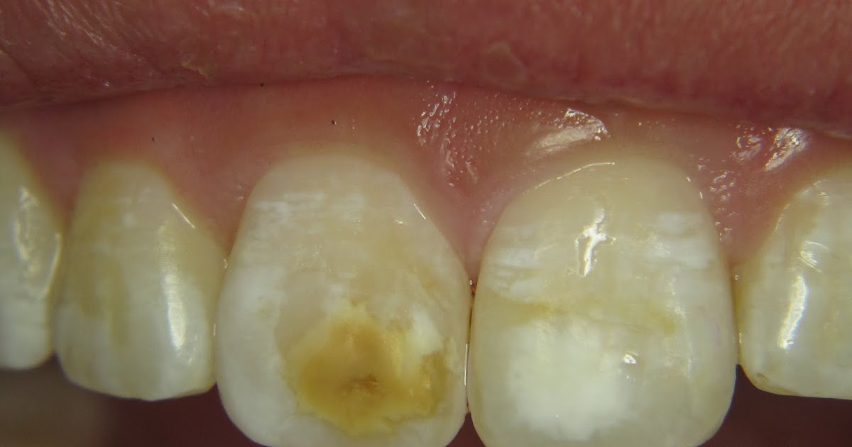 sweet tooth brown stains from fluorosis