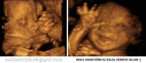 24. haftada ultrason görüntüsü
