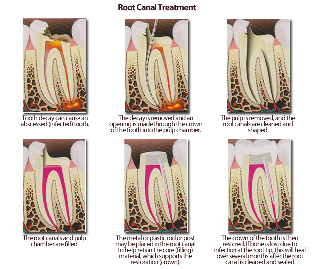 What Is The Purpose Of A Crown After A Root Canal Treatment Dr Pulp's