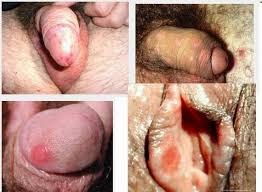 penyakit sipilis cara mngobati sipilis, obat sipilis, cara mengobati nsipilis, sipilis tradisional,