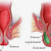 JUAL OBAT WASIR STADIUM 1 thumbnail