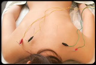 Curing Blood Pressure Levels With Acupuncture