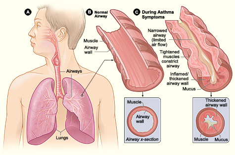 Nursing Interventions for Asthma |.