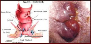 Obat Wasir Herbal Terdaftar Bpom Obat Wasir Herbal Terdaftar Bpom