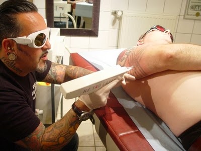 enlever les tatouages au laser tattoo removal
