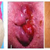 Salep Krim Benjolan Wasir thumbnail