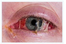 Dog Eye Ulcer Rupture Symptoms Dog Eye Ulcer Rupture Symptoms