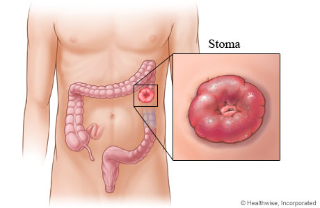what is an ostomy
