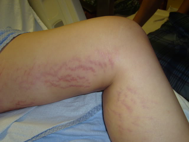 Cara Menghilangkan Stretch Mark Secara Alami Sharegue