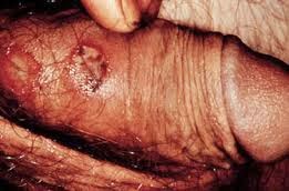 Image Obat sipilis ampuh untuk pria