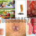 Obat Untuk Benjolan Wasir di Dekat Lubang Pantat thumbnail