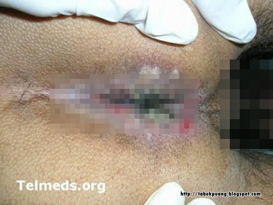 Foto2 Penyakit Sifilis Yang Menyerang Wajah Dan Bagian Tubuh Lain