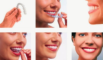 các bước thực hiện invisalign