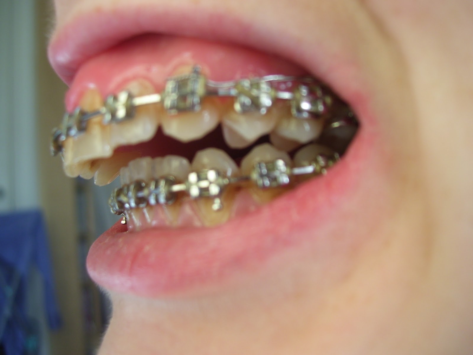 My Jaw Surgery Story 19 months of braces