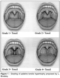 Child Tonsils