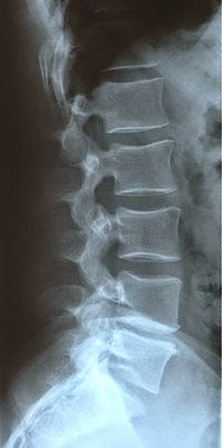 retrolisthesis of cervical spine retrolisthesis of cervical spine