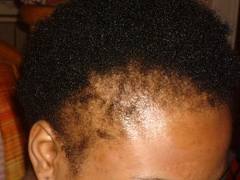 alopecia tempie alopecia tempie