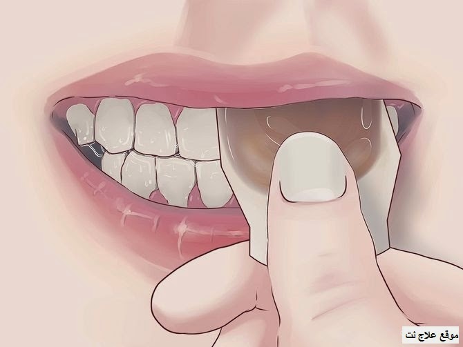علاج التهاب بتطبيق أكياس الشاي اكياس الشاي والتهاب اللثة