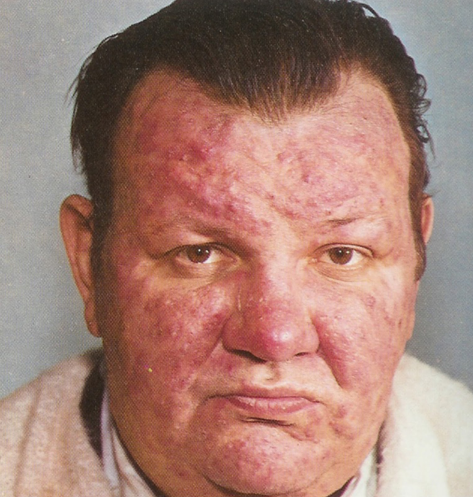 http://4.bp.blogspot.com/-8giz1wCHaPI/UCHWPmBlFpI/AAAAAAAAFLw/lql3eqNWH6I/s1600/man_with_rosacea.jpg
