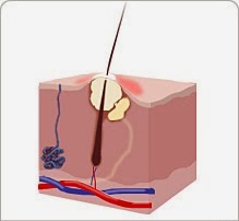 Boutons sur les fesses | médical santé Boutons sur les fesses | médical santé