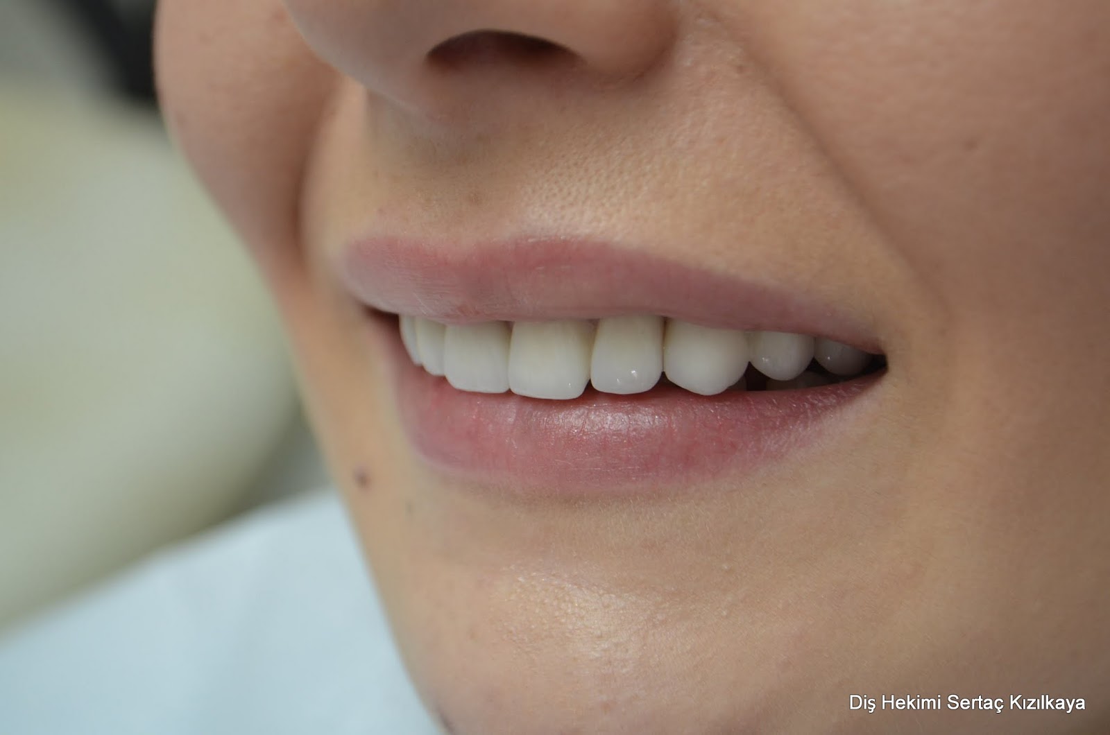 Zirkonyum Diş Nedir? Zirkon, Empress ve porselen diş kaplama fiyatı