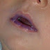 How To Treat Thrush