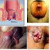 Anus Bengkak dan Berlendir thumbnail