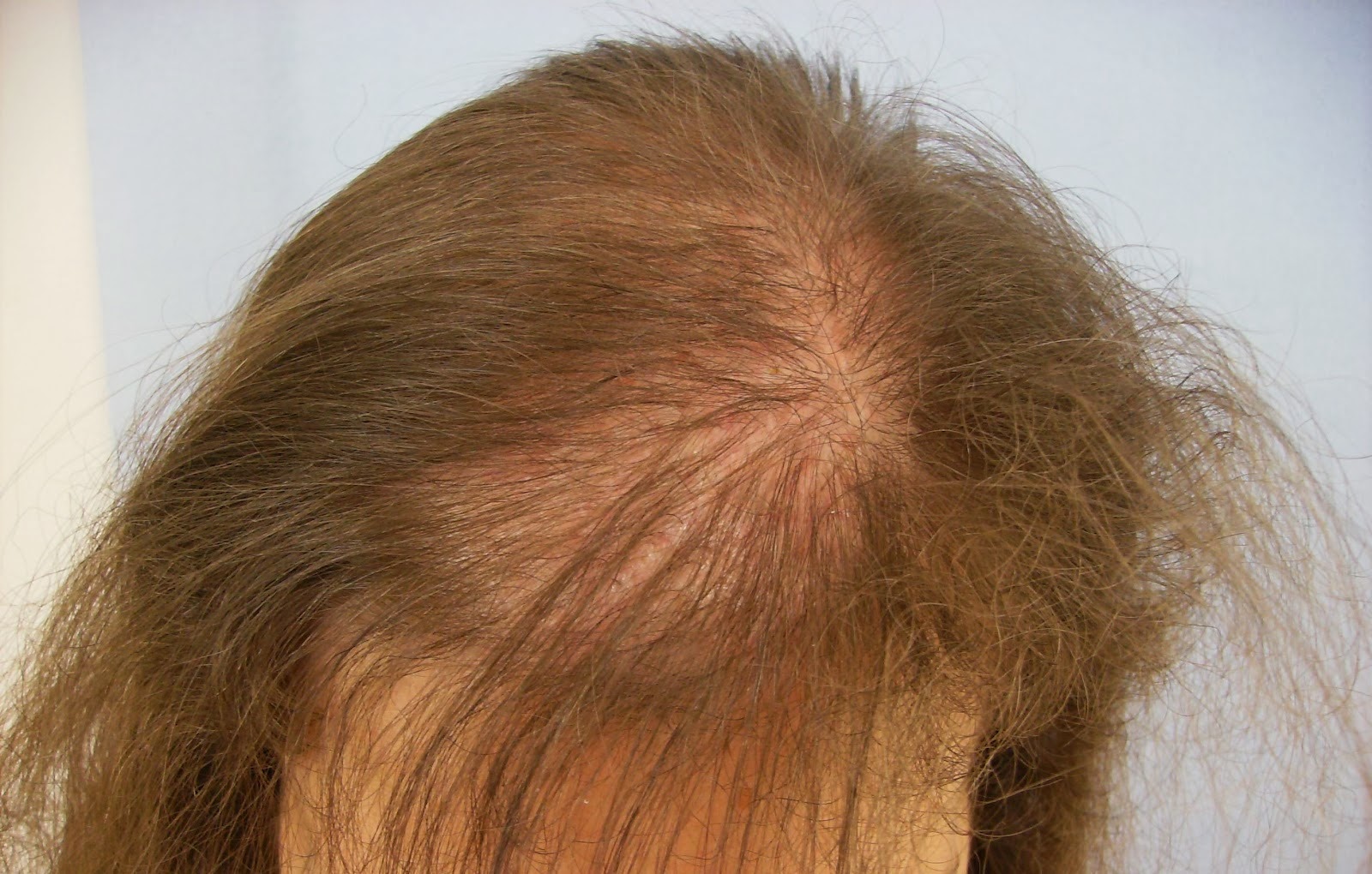 Las caídas de los cabello con la raíz y bolyat las raíces de los cabello