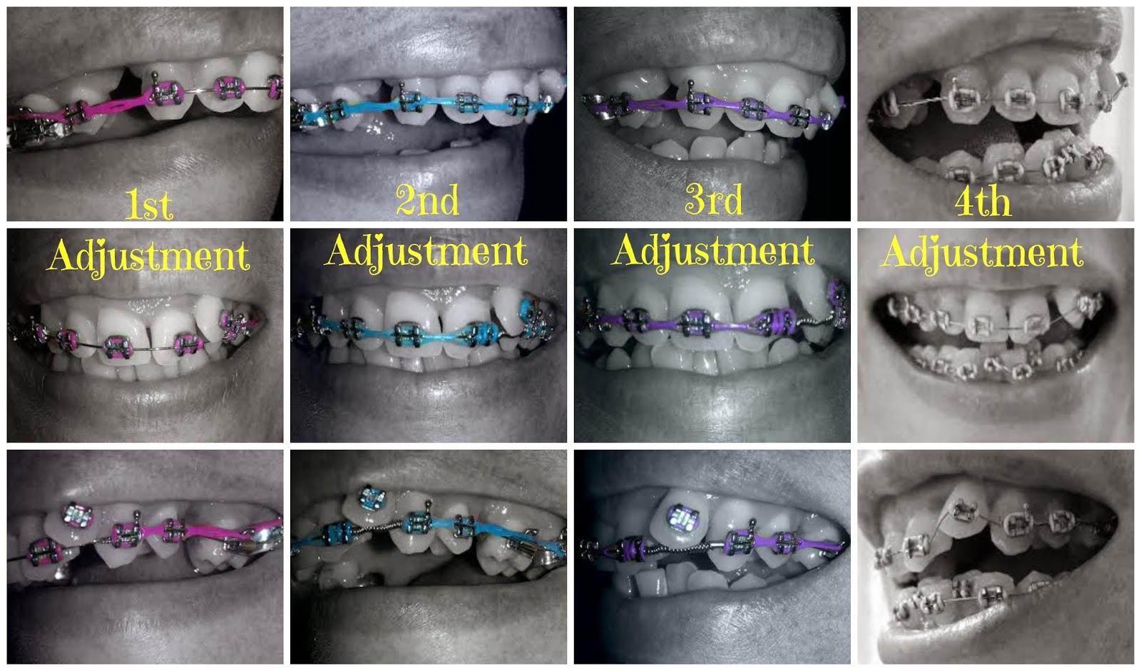 Adult Braces My Journey 4th Braces Adjustment and bottom braces put