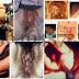Obat Alami Lubang Penis, Vagina, Dubur Bernanah thumbnail