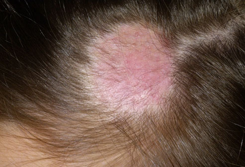 Ringworm On Hair