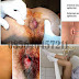 Obat Ambeien Selain Superhoid Manjur thumbnail
