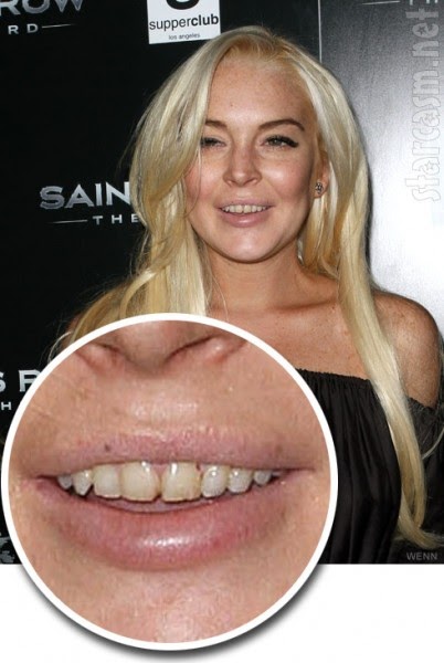 Lindsay Lohans Teeth Dental Damage Lindsay Lohans Teeth Dental Damage