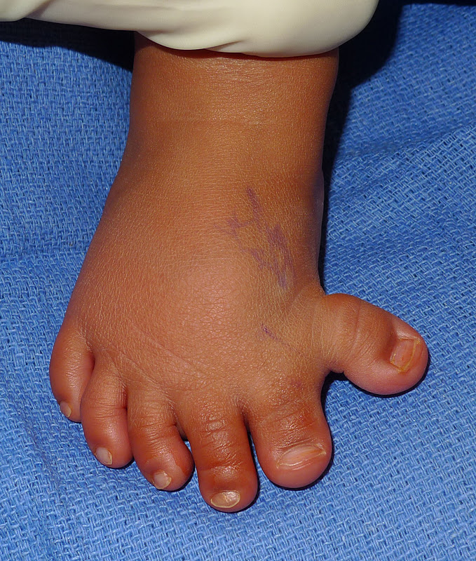 Toe Polydactyly Congenital Hand and Arm Differences