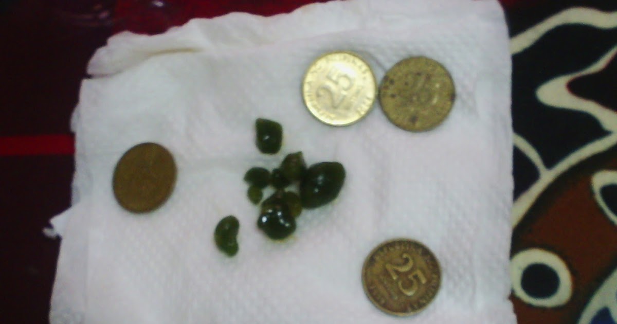 kitchen & health Olive oil para sa gallstones