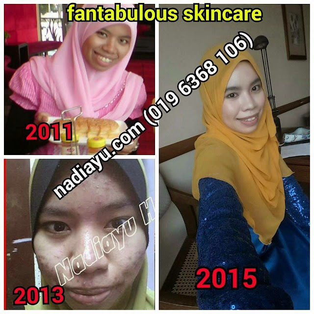 fantabulous, Fantabulous beaute, fantabulous skincare, jeragat, jerawat, jerawat batu, jerawat bernanah, jerawat halus, kulit berminyak, kulit gelap, kulit kering, kulit kusam, testimoni fantabulous 