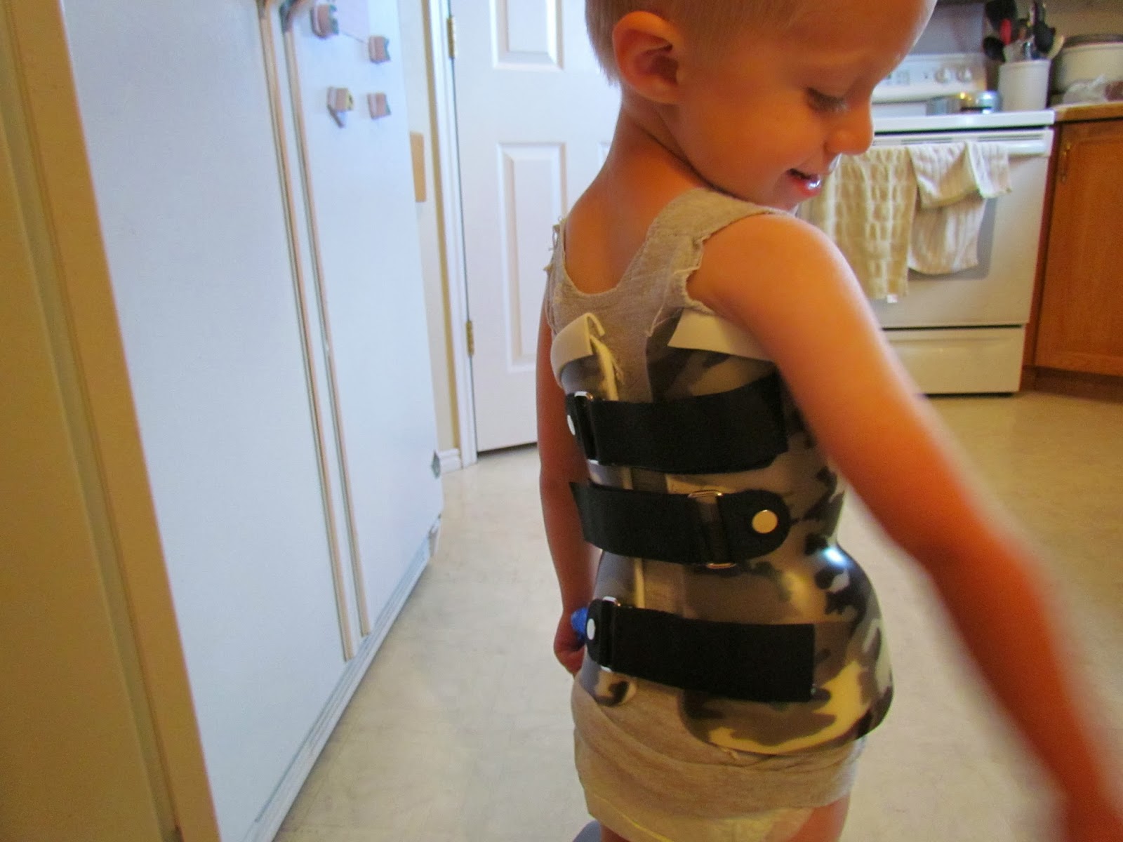 Our Journey through Progressive Infantile Scoliosis pictures of brace