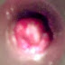 Gejala Wasir Ambeven thumbnail