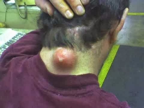Como lutar com enguias de um acne