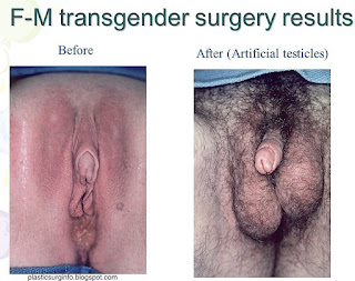 Female to male genital after change photo result