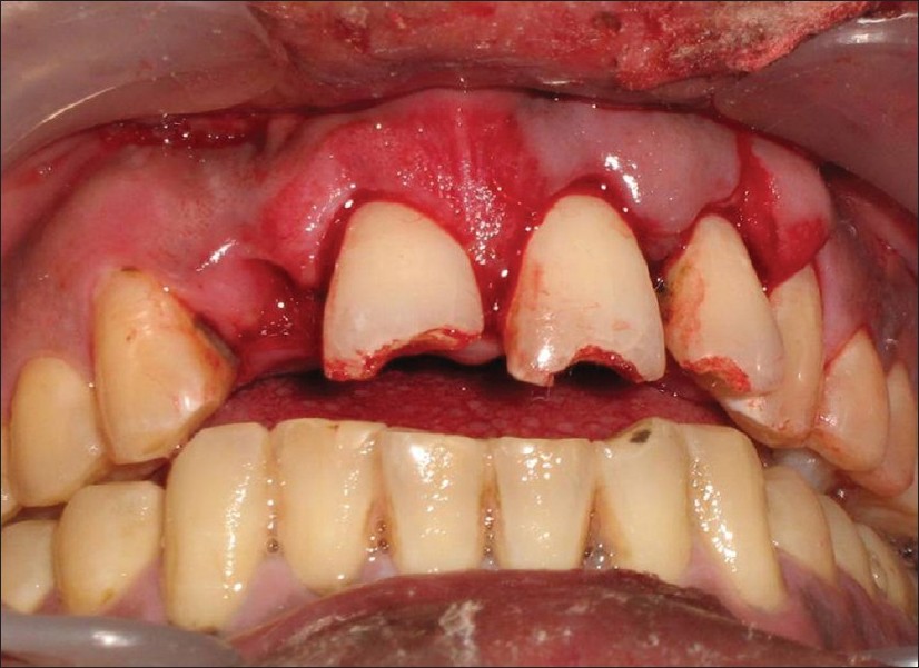 lateral incisor