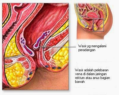 wasir wasir