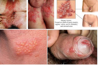 Gambar Penyakit Herpes