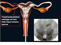 Cara Mengatasi Tuba Falopi yang Tersumbat Cara Mengatasi Tuba Falopi yang Tersumbat