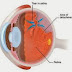 Cara mengobatan Untuk Penyakit Ablasio Retina