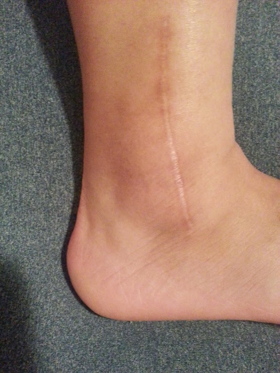 My Broken Ankle =( 2 years 2 Years Ankleversary!