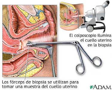 Biopsia de cuello uterino